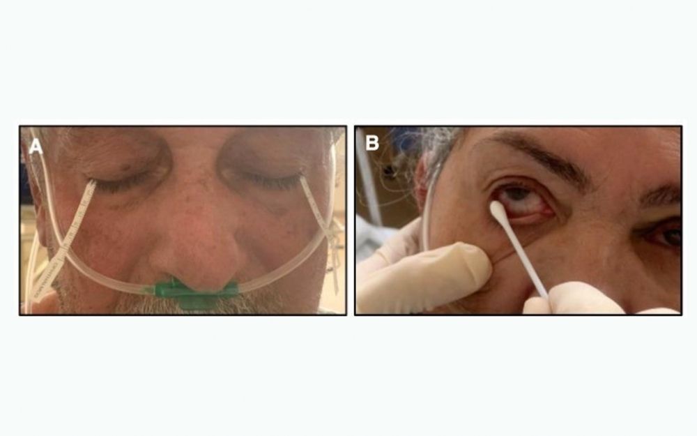 Cientistas utilizaram duas estratégias para coletar as lágrimas: o swab conjuntival (à esquerda) e as tiras de Schirmer / Luiz Fernando Manzoni Lourençone/USP