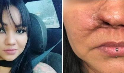 Dentista é indiciado após paciente perder parte do nariz em Goiás