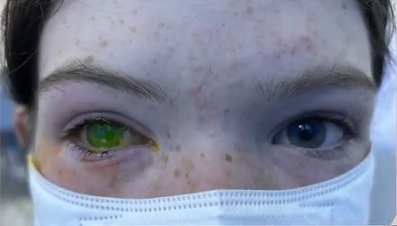 doenca-ocular-australia