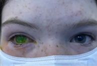 Doença deixa olho esverdeado e provoca dor intensa em pacientes na Austrália