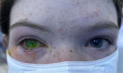 Doença deixa olho esverdeado e provoca dor intensa em pacientes na Austrália