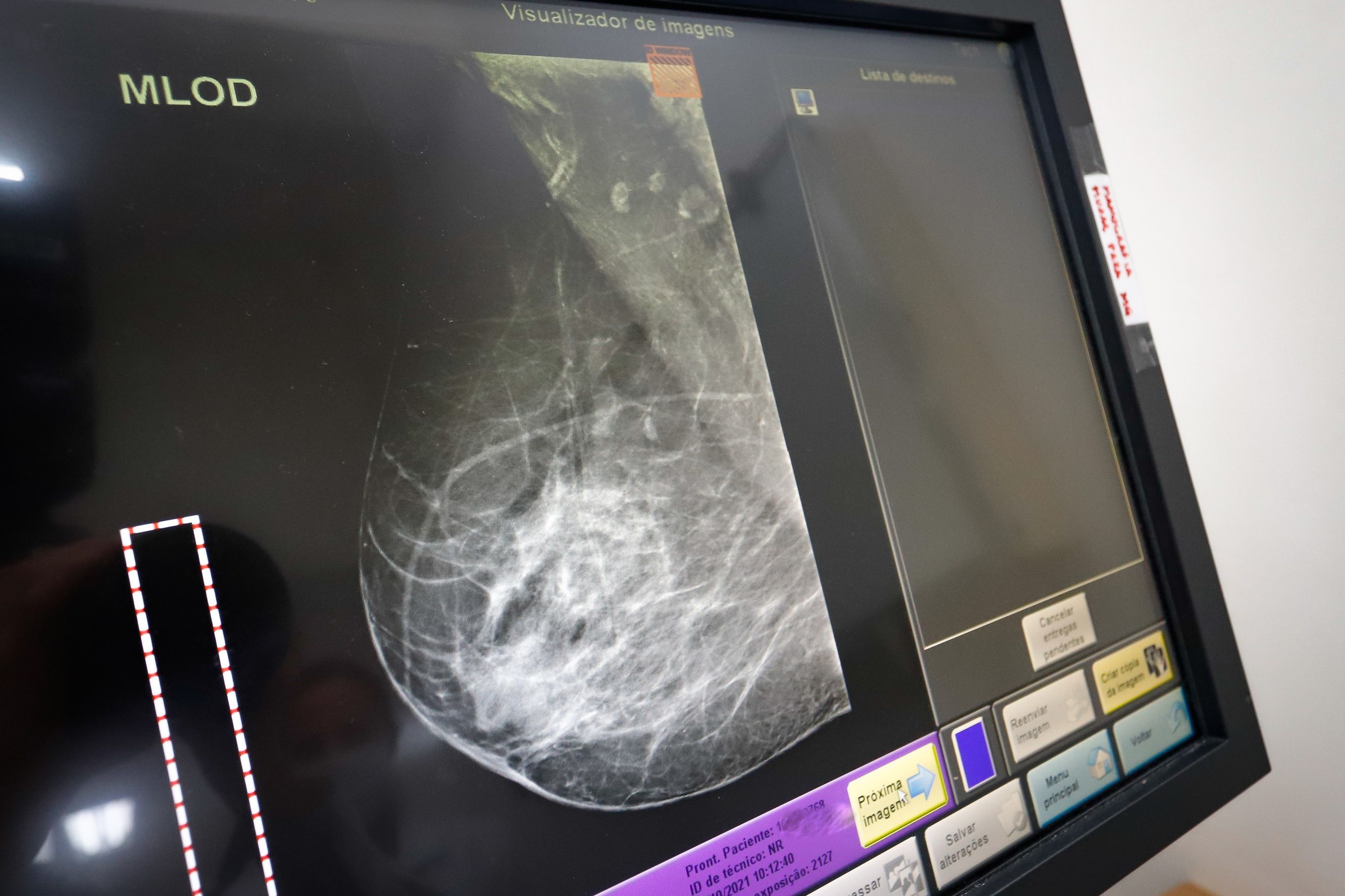 Exame de mamografia | diagnóstico câncer de mama
