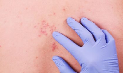 Ministério da Saúde decide não incorporar vacina do herpes zóster ao SUS