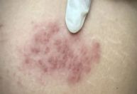 Risco de herpes-zóster aumenta depois dos 50 anos, diz médico a dr. Kalil