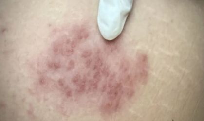 Herpes-zóster: conheça causas, sintomas e tratamento