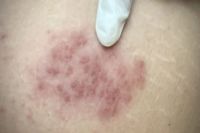 Risco de herpes-zóster aumenta depois dos 50 anos, diz médico a dr. Kalil