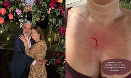 Natasha Dantas, esposa de Bonner, mostra cortes após ter cordão furtado