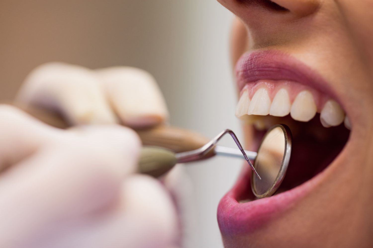 O ideal é que, para aplicar as lentes de contato, os dentes apresentem mais de 50% da superfície de esmalte / Freepik/Reprodução