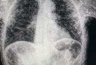 Radiografia de tórax viraliza na internet; entenda os riscos da cisticercose