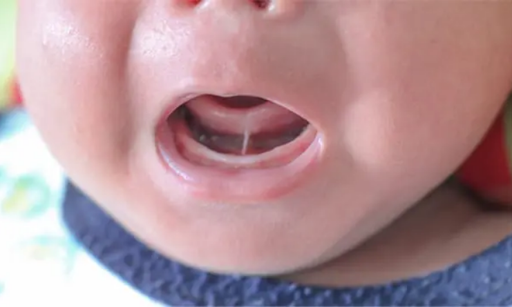 Frenectomia é procedimento comum em recém-nascidos e evita que a criança tenha língua presa. / Johnston Dental Care
