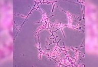 Primeiros casos de micose resistente ao tratamento são relatados nos EUA