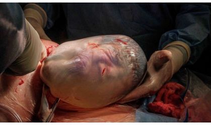 Instante raro: mulher dá à luz gêmeos e um dos bebês nasce empelicado