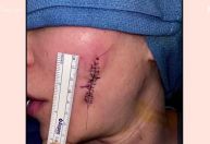 Khloé Kardashian mostra cicatriz no rosto após remoção de melanoma