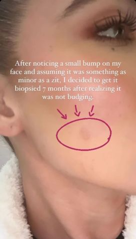 Em outubro de 2022, Khloé compartilhou com os seguidores que havia feito uma biópsia e posterior remoção de tumor de seu rosto / Instagram/@khloekardashian/Reprodução