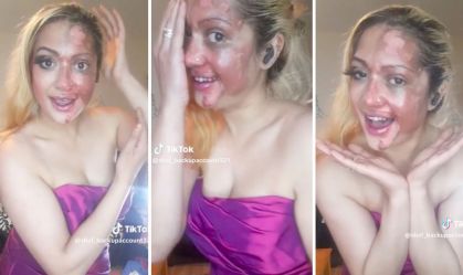 Mulher que teve queimaduras com explosão de ovo em seu rosto viraliza no TikTok