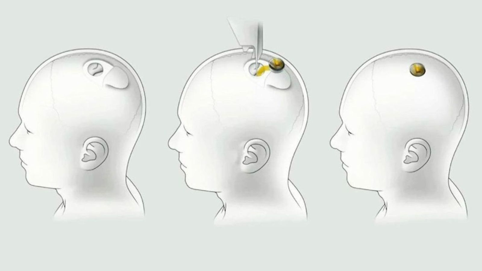 neuralink-empresa-de-implantes-de-elon-musk