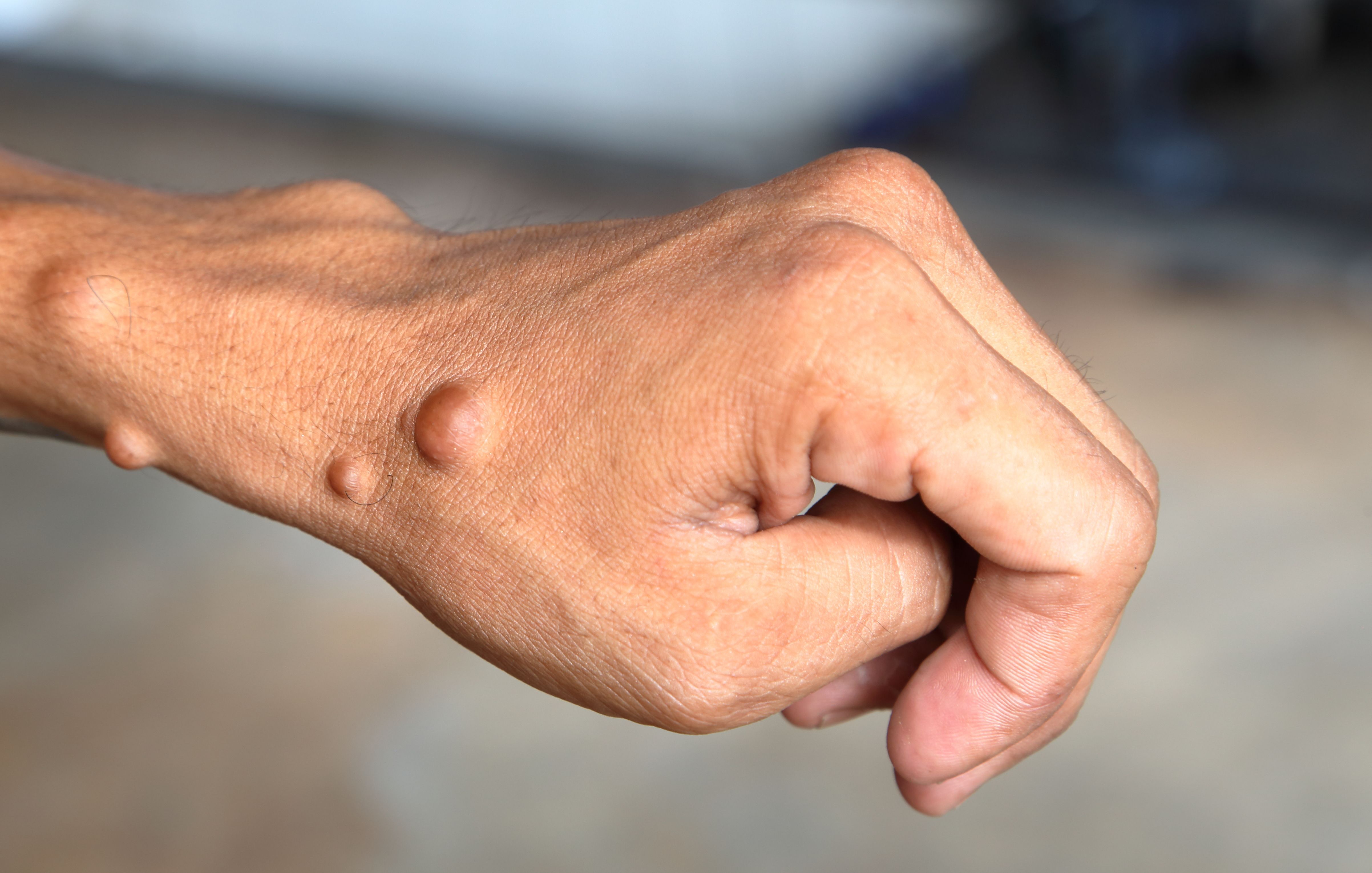 neurofibromatose