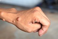 Neurofibromatose: o que é, quais são os sintomas e riscos da doença