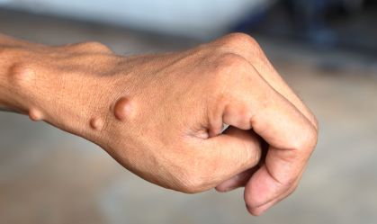 Dia Mundial da Neurofibromatose: o que é, quais são os sintomas e riscos da doença
