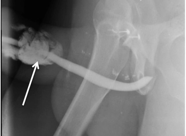 Ultrassonografia peniana mostrou fratura tripla / International Journal of Surgery Case Reports