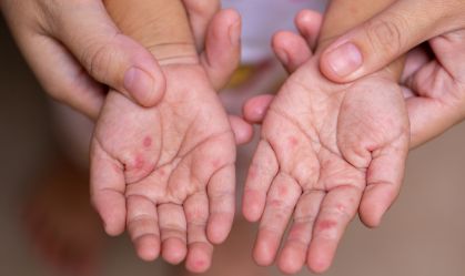 Escolas infantis de Porto Alegre registram surtos da síndrome mão-pé-boca