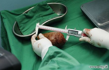 Médicos do Sri Lanka removem maior pedra do rim do mundo