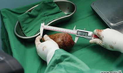 Médicos do Sri Lanka removem maior pedra no rim do mundo; veja fotos