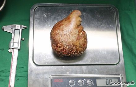Médicos do Sri Lanka removem maior pedra do rim do mundo
