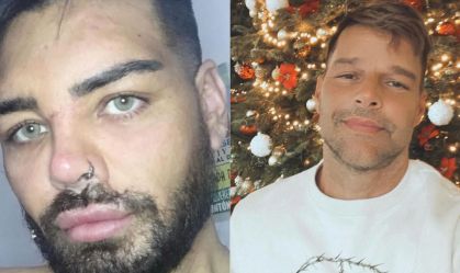 Argentino faz mais de 30 cirurgias plásticas para se parecer com Ricky Martin; compare