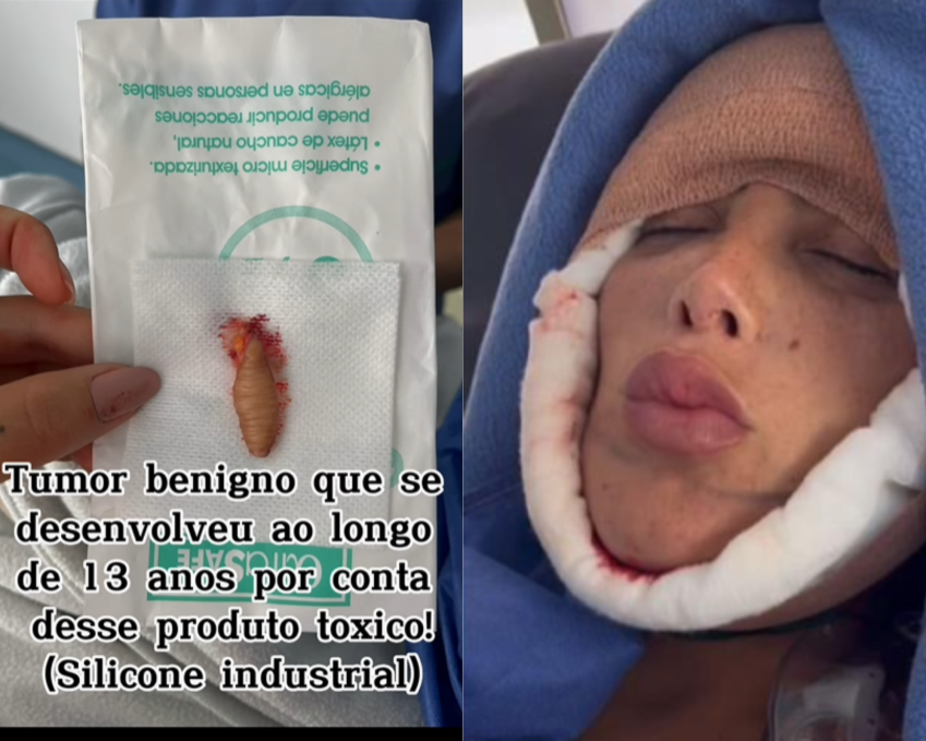 Marcella Maia mostra subestância retirada do seu rosto / Reprodução/.Instagram/@mmaia