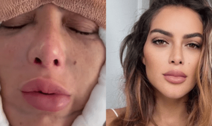 Silicone industrial: atriz passa por cirurgia de retirada de substância do rosto
