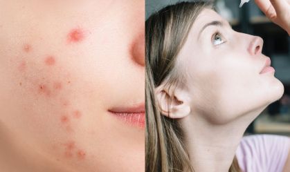 Suavizar espinhas com colírio funciona? Entenda riscos de truque que viralizou