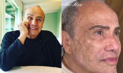 Aos 91 anos, Stênio Garcia passa por transformação e exibe harmonização facial
