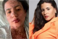 Síndrome de Stevens-Johnson: conheça a doença que afetou mulher de Frank Aguiar