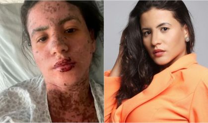 Síndrome de Stevens-Johnson: conheça a doença que afetou mulher de Frank Aguiar