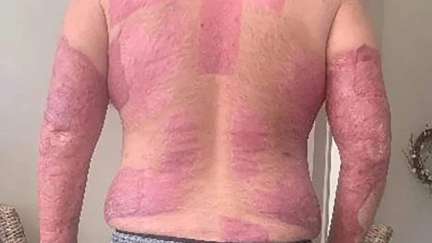 Imagens dos ferimentos de Matthew Urey infligidos durante a erupção de Whakaari/White Island. / Lipcon, Margulies, Alsina & Winkleman