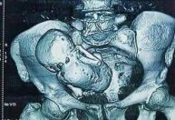 Bebê de pedra: entenda como fetos podem continuar no corpo humano por anos
