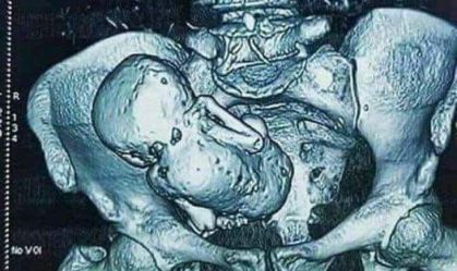 Bebê de pedra: entenda como fetos podem continuar no corpo humano por anos