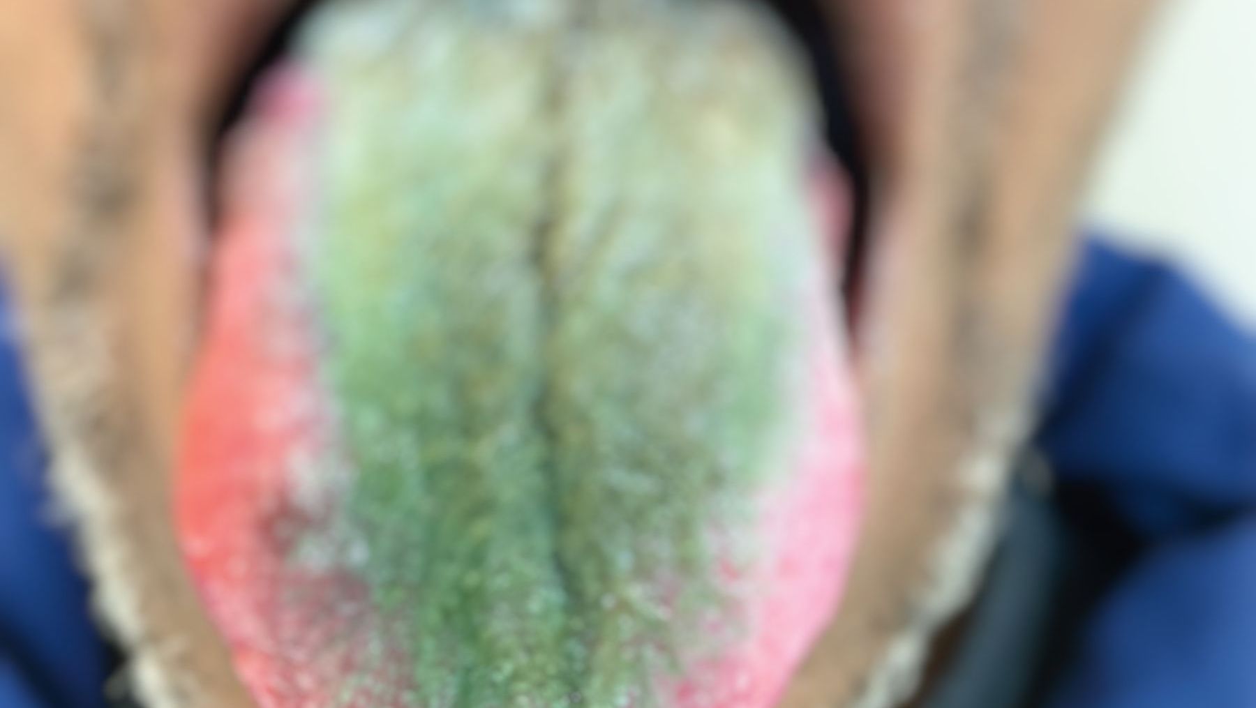 Imagem de destaque do post: Americano fica com a língua verde e peluda após misturar cigarro e antibiótico