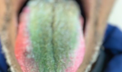 Americano fica com a língua verde e peluda após misturar cigarro e antibiótico