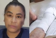 Funkeira MC Katia tem parte do pé amputado após problema de saúde