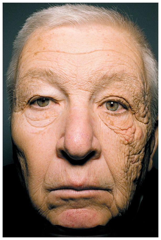 Foto mostra danos causados na pele de caminhoneiro após 28 anos de exposição ao Sol. / New England Journal of Medicine