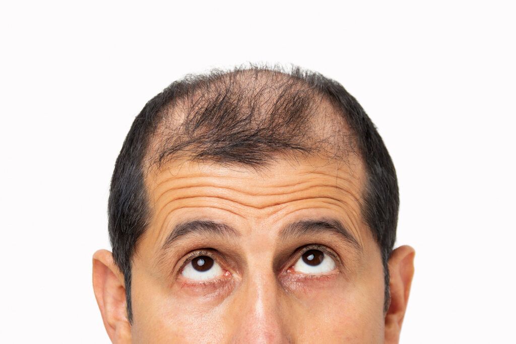 Recomendação para tratar o cabelo com queda / Imagem: Shutterstock