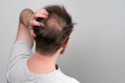 O que pode ser quando o cabelo está caindo muito?