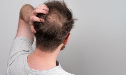 Minoxidil, finasterida e outros: benefícios e riscos de medicamentos contra a calvície