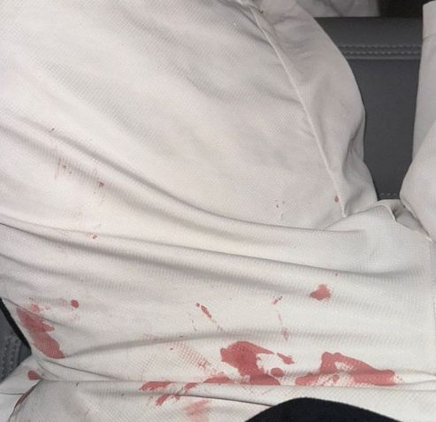 Luan publicou foto com calção machando de sangue. / Reprodução / Instagram