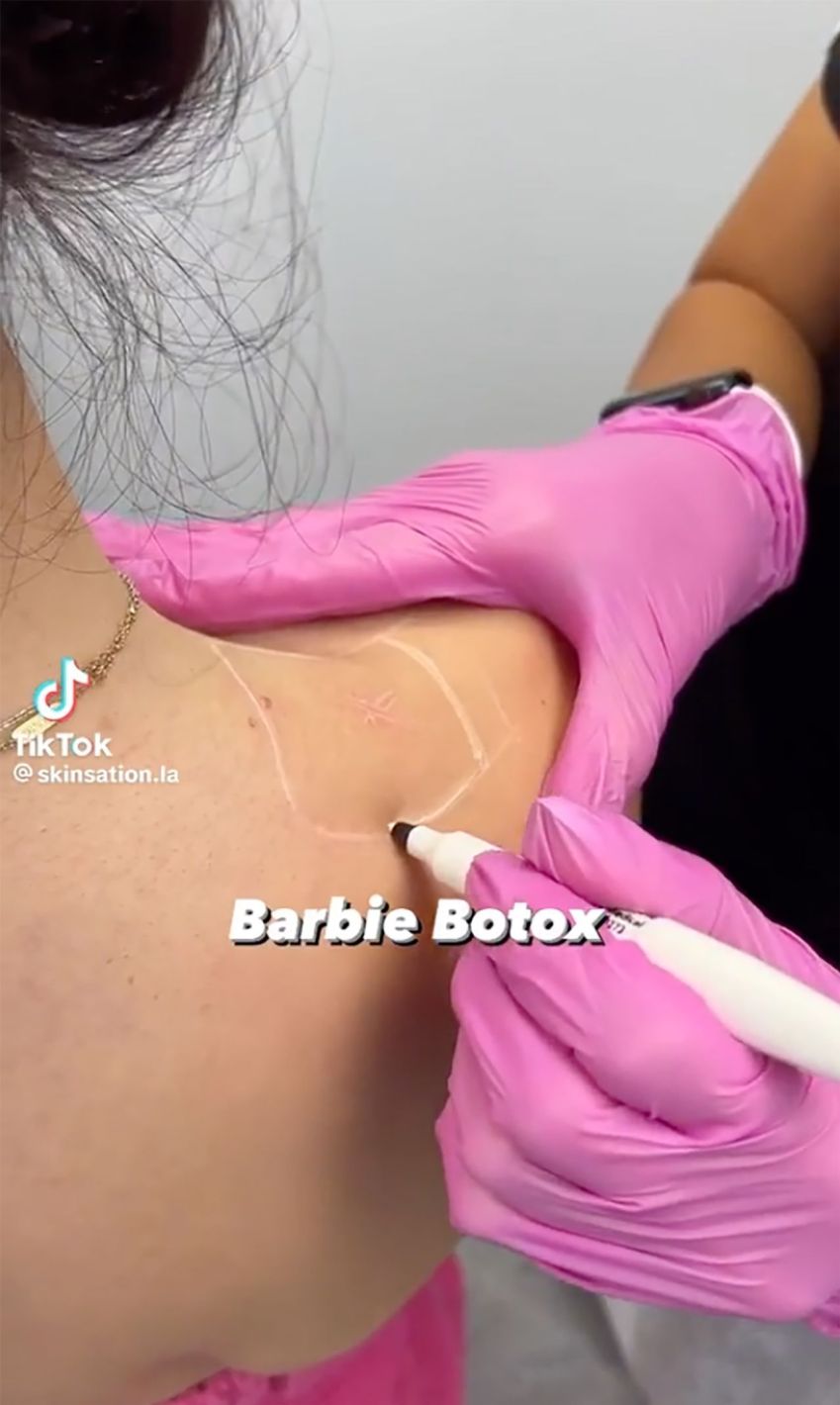 Clientes estão recebendo uma injeção de neurotoxina nos ombros para liberar a tensão e afinar a aparência do pescoço. / @skinsation.la/TikTok