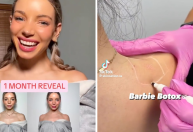 O que é o “Botox da Barbie”, a mais recente obsessão de beleza do TikTok