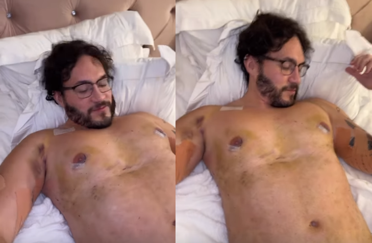Eliezer exibe corpo cheio de roxos após ginecomastia / Reprodução/Instagram