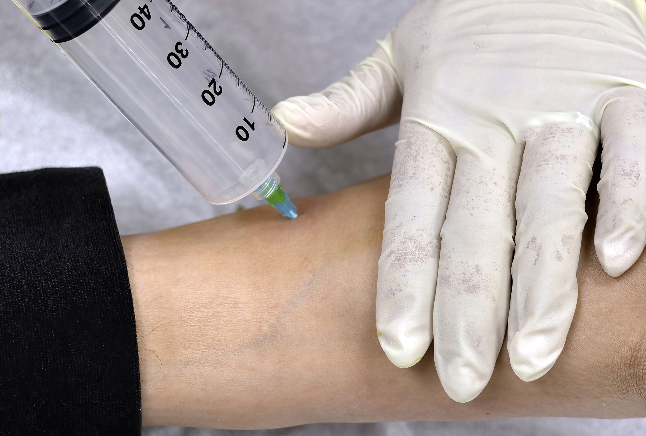 Ozone Injection into Ankle